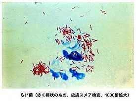 Вирус или бактерия - что вызывает лепру?