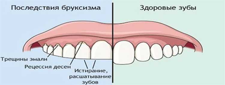 Причины скрежета зубов